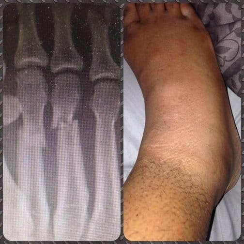 Тайрон Вудли сломал ногу в поединке с Келвином Гастелумом