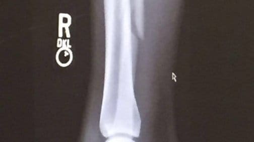 Питбуль сломал малоберцовую кость голени