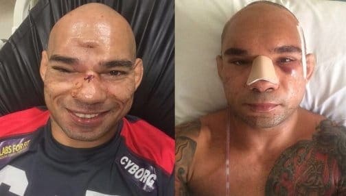 Киборг Сантос успешно прооперирован