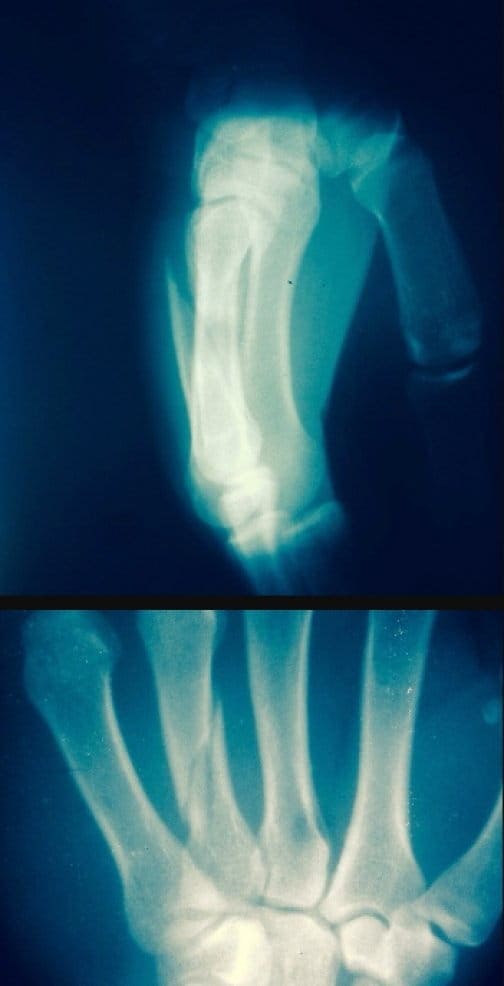 Турал Рагимов травмировал обе руки в поединке с Иваном Бучингером