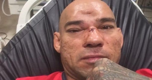 Евангелиста Сантос получил тяжелый перелом лобной кости
