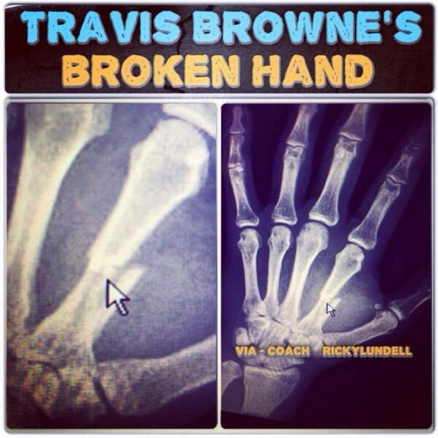 Тренер Трэвиса Брауна опубликовал снимок сломанной руки тяжеловеса