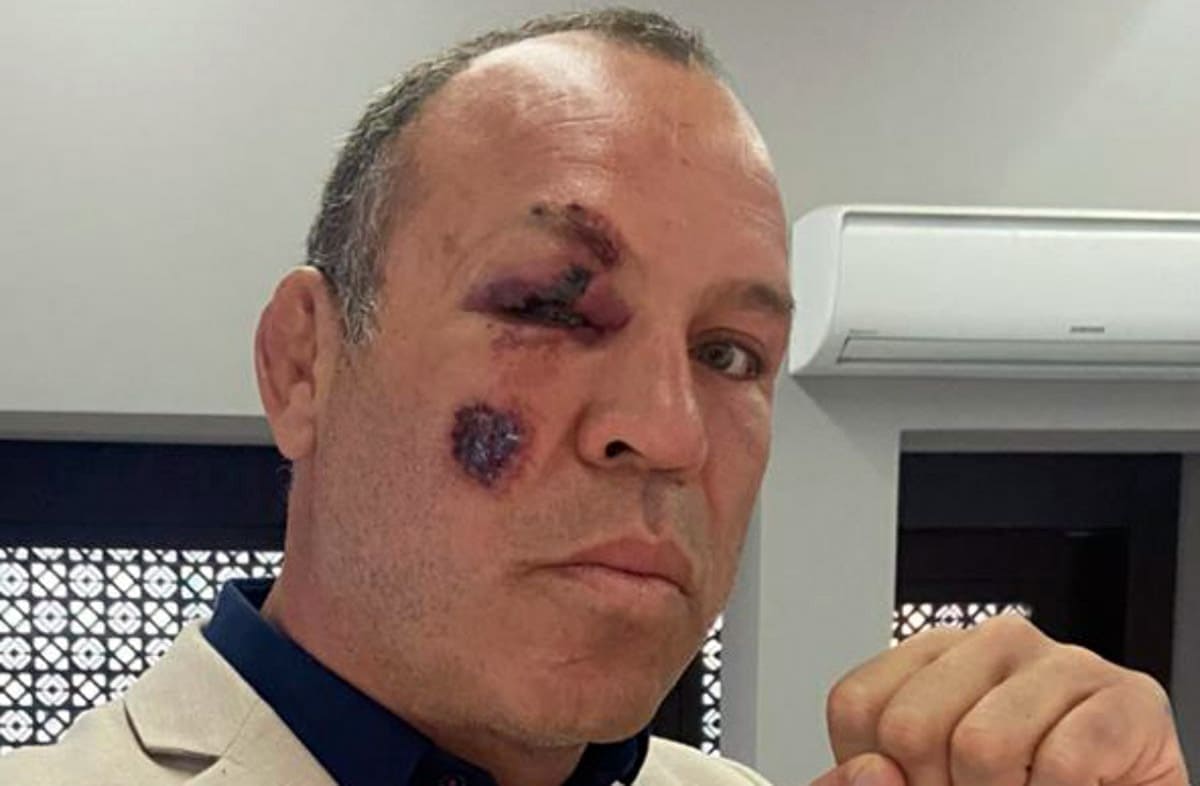 MMA legend Wanderlei Silva was injured in a collision between his bicycle and a car.
