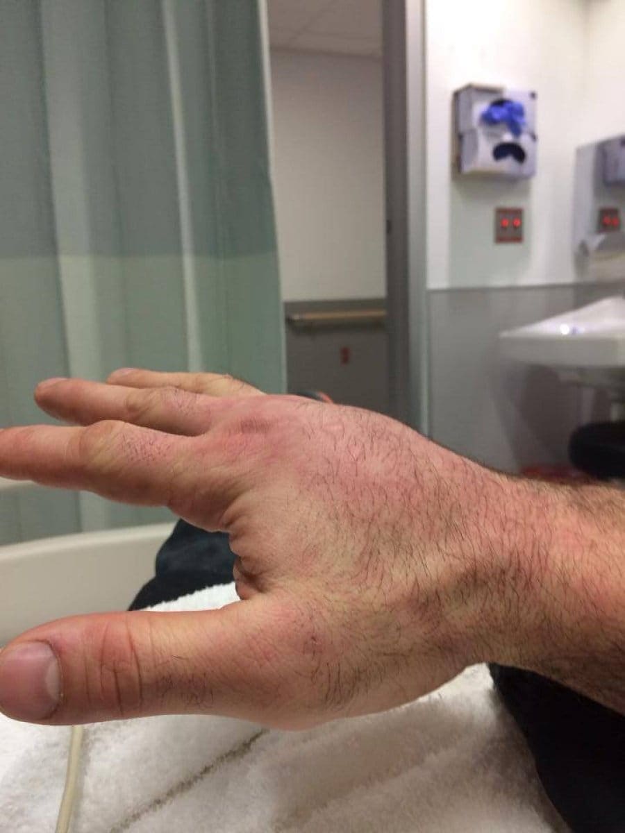 Габриэль Гонзага сломал руку