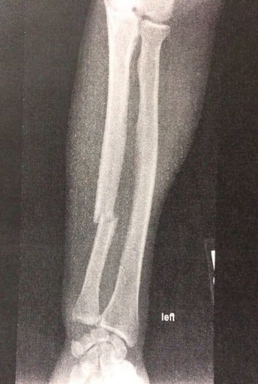 Холли Холм сломала руку в титульном поединке с Джулианой Вернер