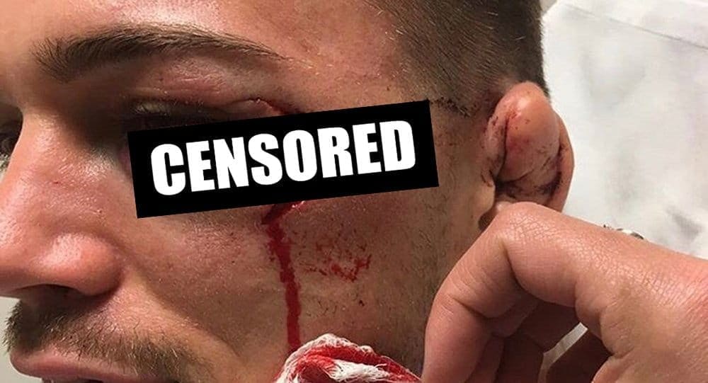 Фото дня: страшное рассечение Бреннана Уорда
